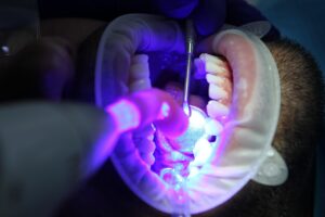 LEDホワイトニングの体験談は本当か？